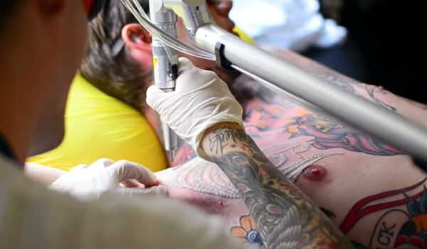 Remoção de tatuagem tattoo laser - Homem No Espelho