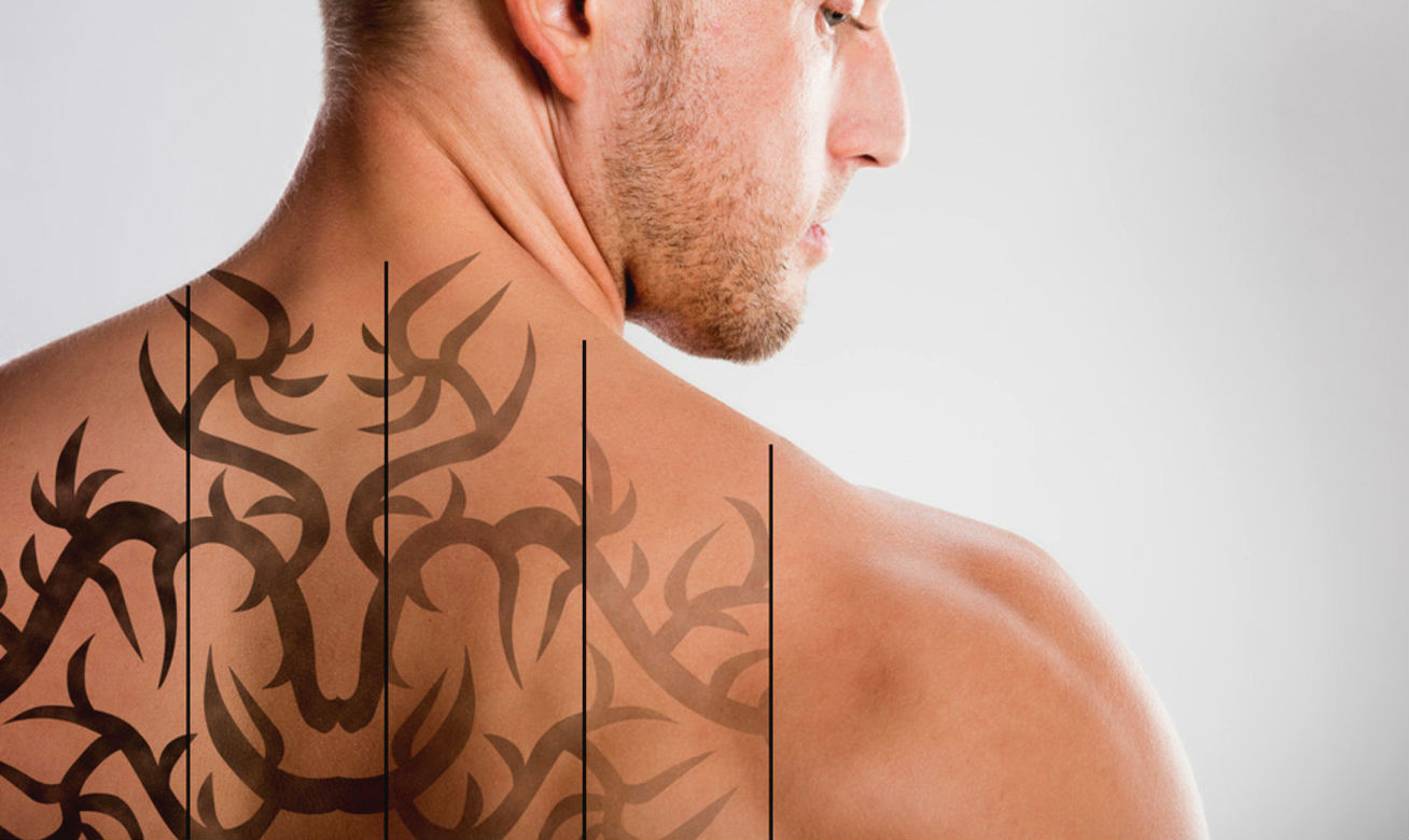 Remoção de tatuagem tattoo laser - Homem No Espelho