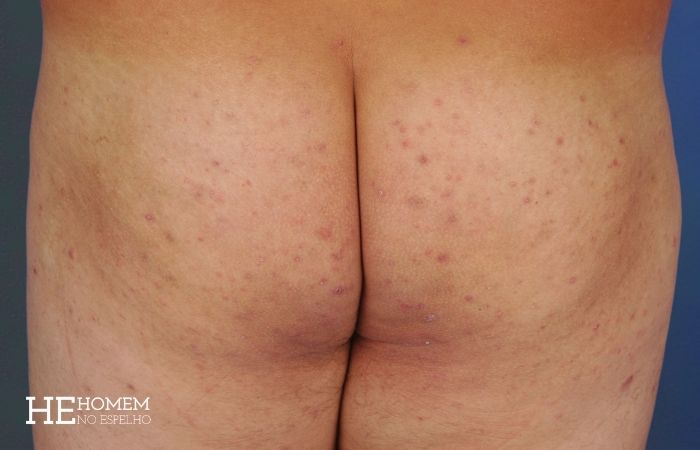 Homem No Espelho - Espinhas na bunda