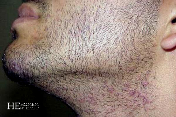 Homem No Espelho - Foliculite na barba como prevenir e tratar
