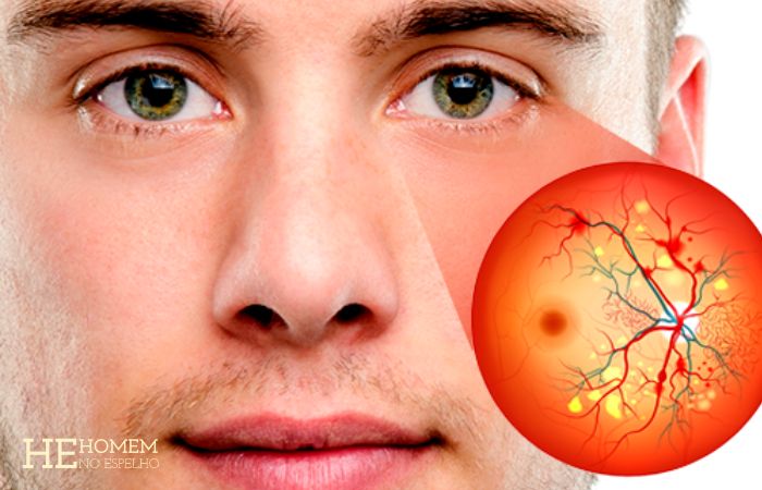 Homem No Espelho - malefícios do açúcar - olhos - retinopatia diabética
