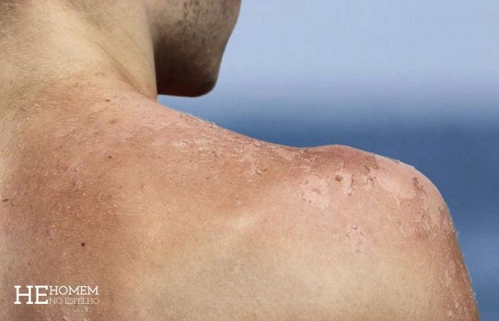 Homem No Espelho - A queimadura da praia não é o pior dano do sol na pele