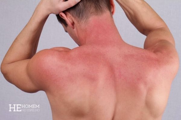 Homem No Espelho - A queimadura da praia não é o pior dano do sol na pele